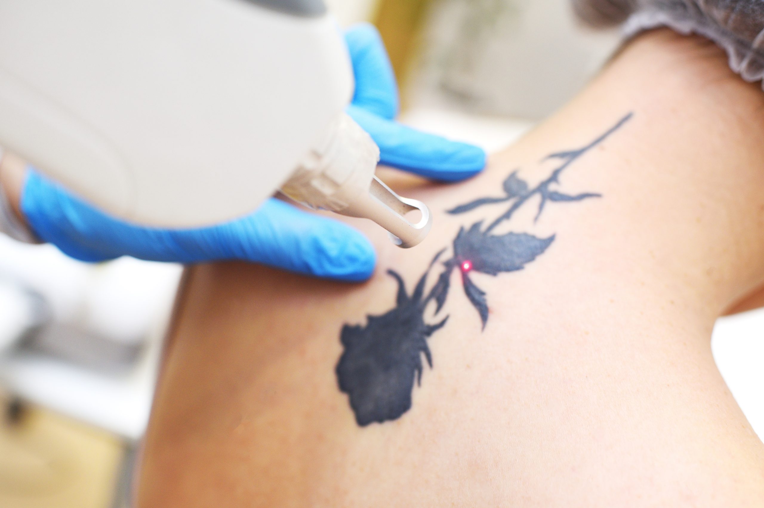 tattoo removal shutterstock
